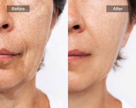 Nouveau Masque Laser Visage Glowera™ – Peau Plus Jeune